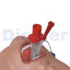 Tubo Laringeo Vbm Ilts-D